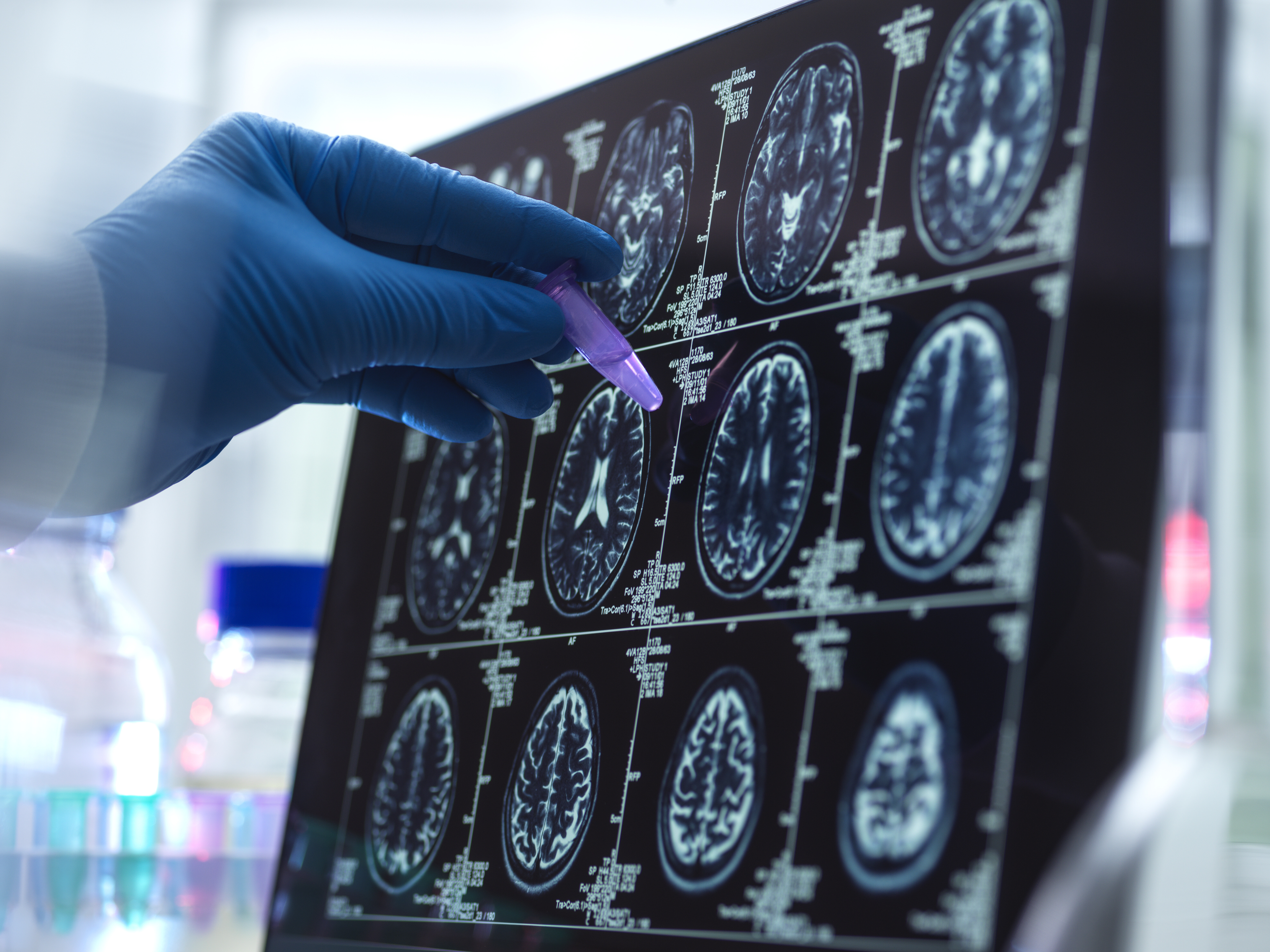 Understanding Four Common Neurological Diseases: Causes, Symptoms, and Treatments