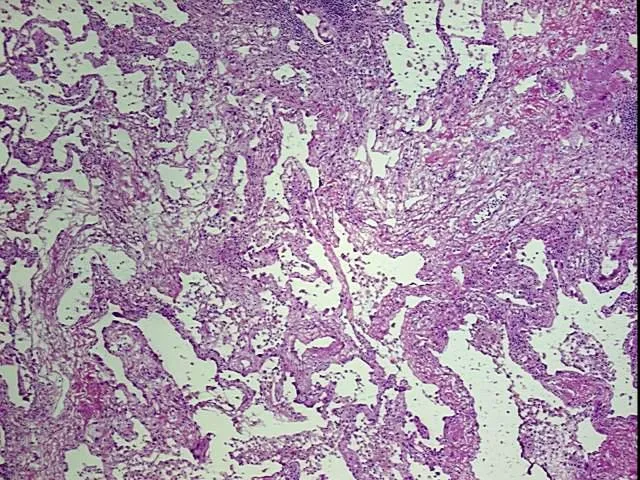 Frozen Tissue Blocks, Lung - image 1
