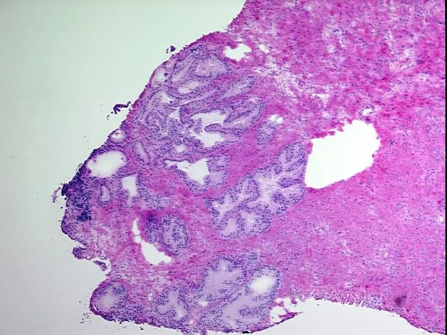 Frozen Tissue Blocks, Prostate - image 1