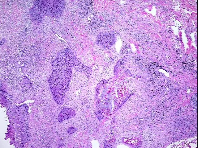 Frozen Tissue Blocks, Lung - image 1