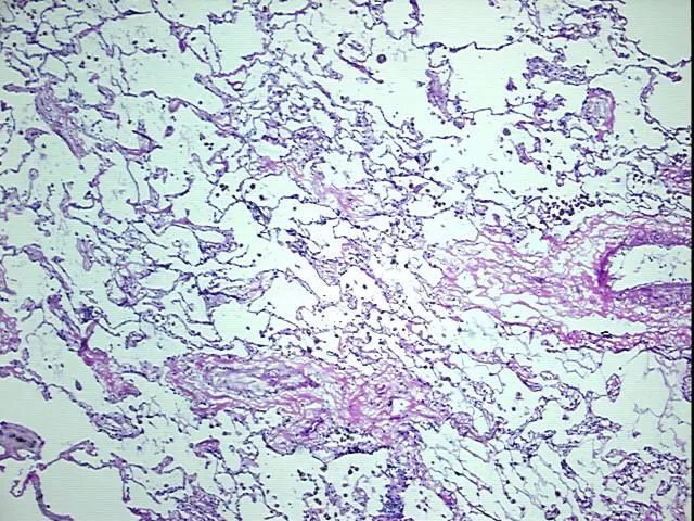 Frozen Tissue Blocks, Lung - image 1