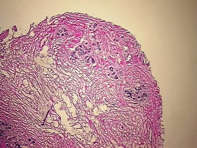 Frozen Tissue Blocks, Breast - image 1