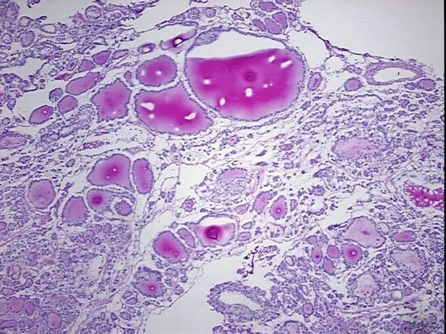 Frozen Tissue Blocks, Thyroid gland - image 1