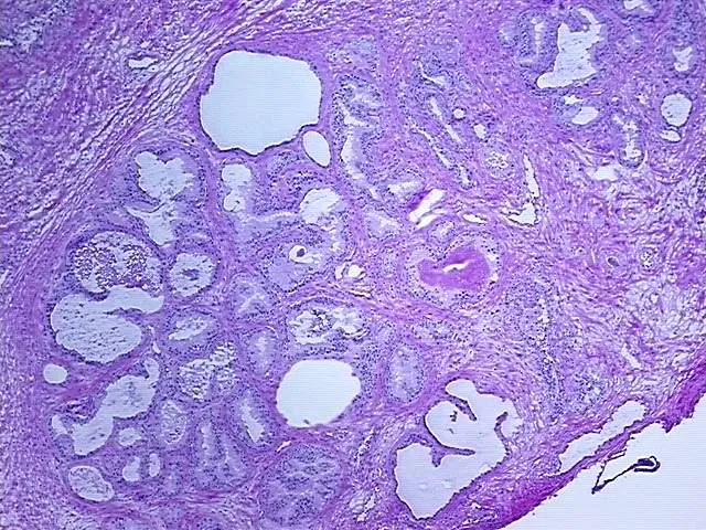 Frozen Tissue Blocks, Prostate - image 1