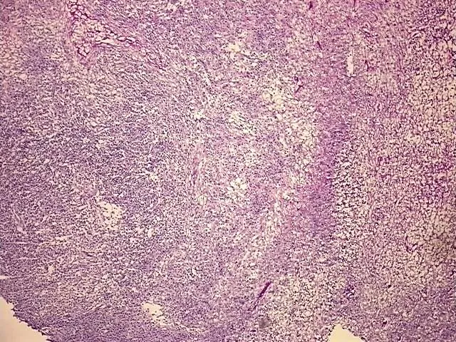 Frozen Tissue Blocks, Lymph node - image 1