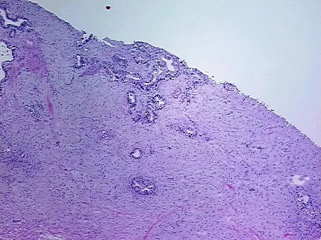 Frozen Tissue Blocks, Gallbladder - image 1