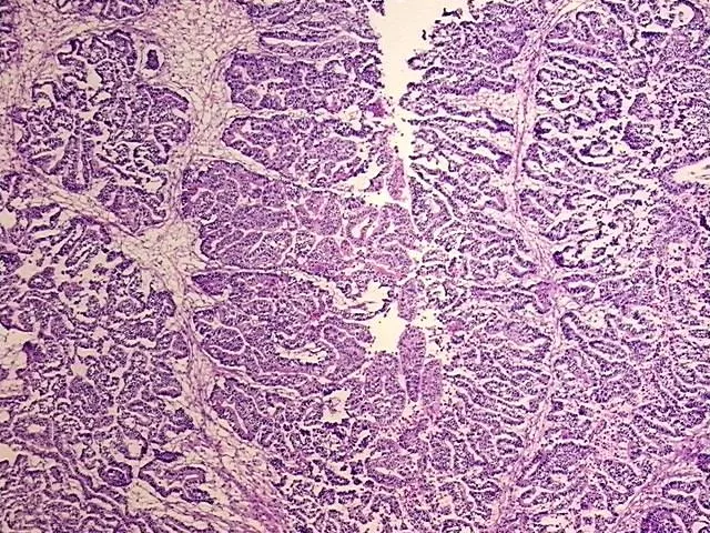Frozen Tissue Blocks, Cervix - image 1