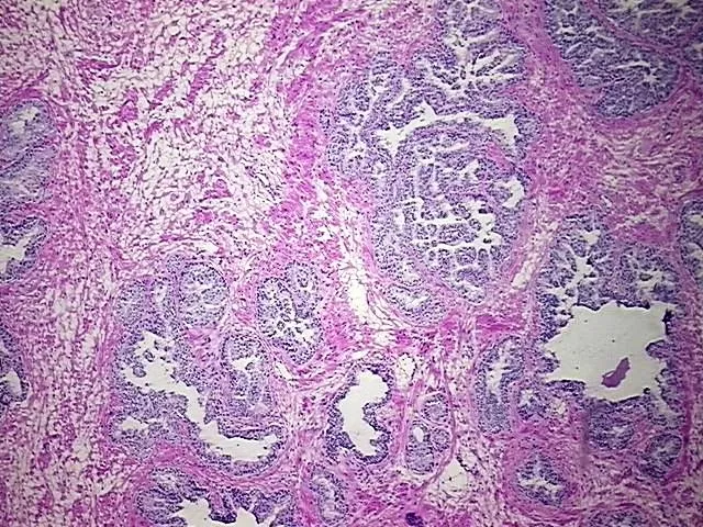 Frozen Tissue Blocks, Prostate - image 1