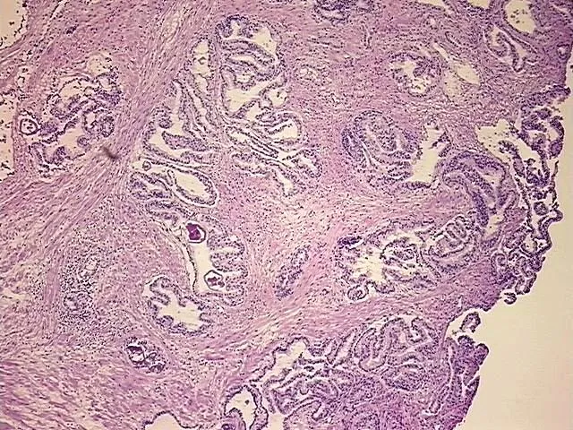 Frozen Tissue Blocks, Prostate - image 1