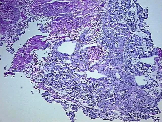 Frozen Tissue Blocks, Ovary: bilateral - image 1