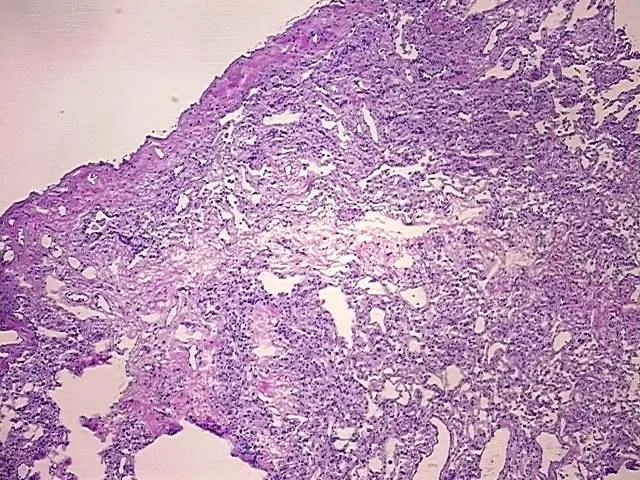 Frozen Tissue Blocks, Lung - image 1