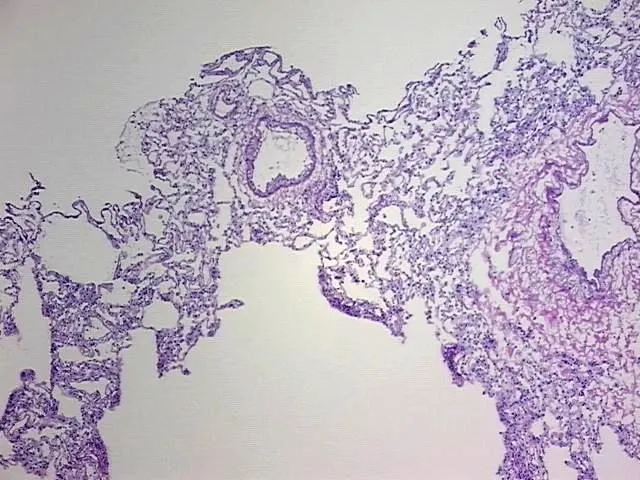 Frozen Tissue Blocks, Lung - image 1