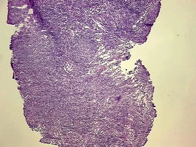 Frozen Tissue Blocks, Lymph node - image 1