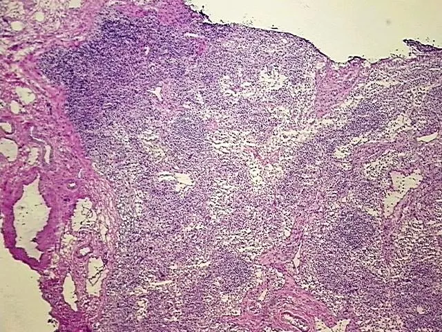 Frozen Tissue Blocks, Lymph node - image 1