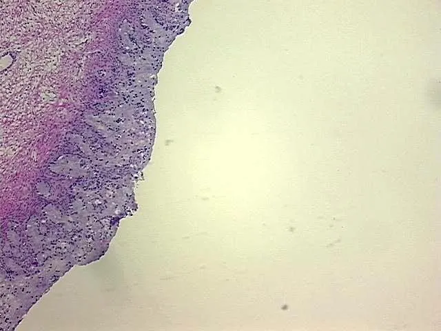 Frozen Tissue Blocks, Gallbladder - image 1
