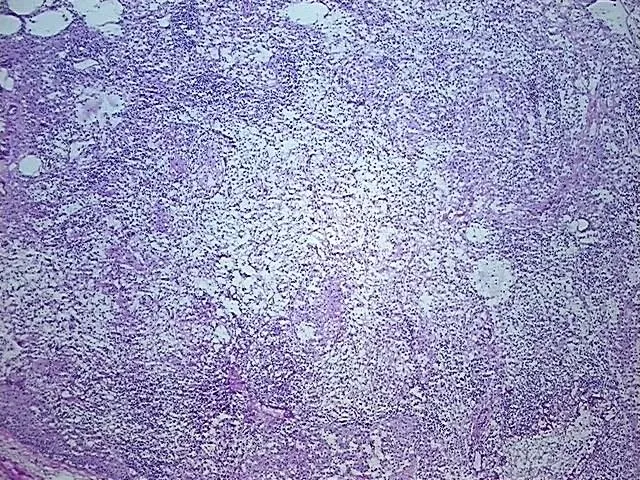 Frozen Tissue Blocks, Lymph node - image 1