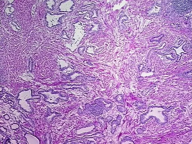 Frozen Tissue Blocks, Prostate - image 1
