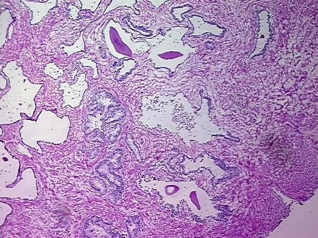 Frozen Tissue Blocks, Prostate - image 1