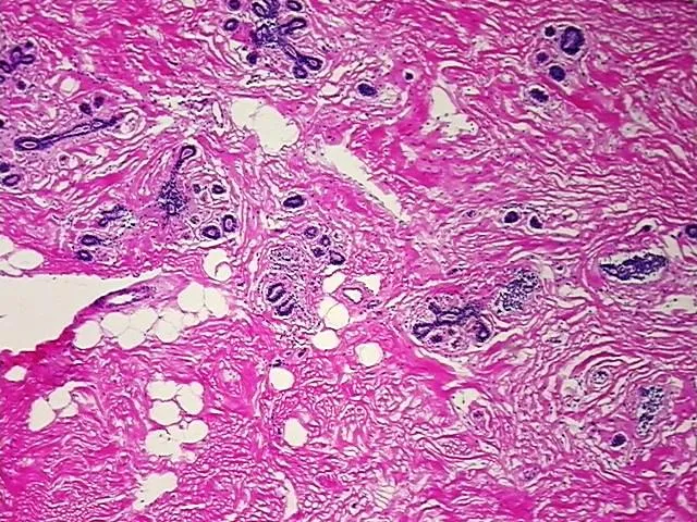 Frozen Tissue Blocks, Breast - image 1