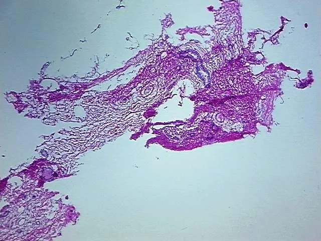 Frozen Tissue Blocks, Breast - image 1