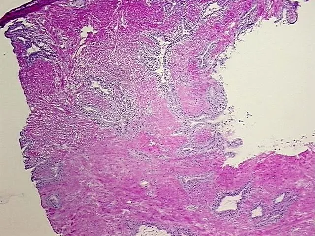 Frozen Tissue Blocks, Prostate - image 1
