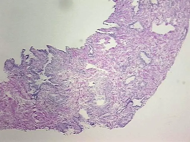 Frozen Tissue Blocks, Prostate - image 1