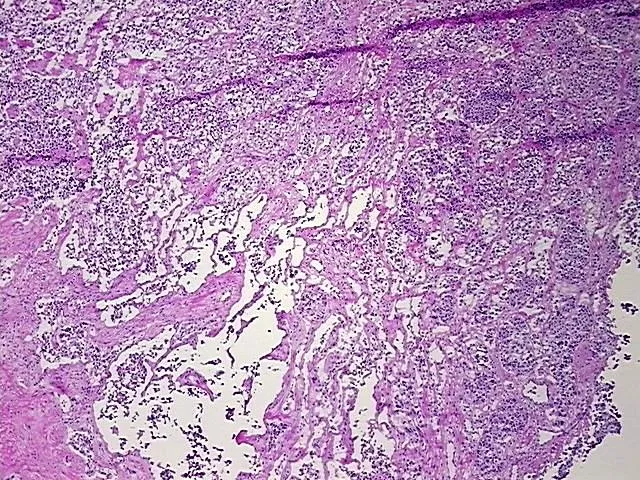 Frozen Tissue Blocks, Unknown tissue consistent with neuroendocrine origin - image 1