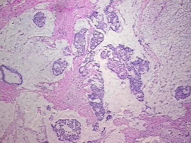 Frozen Tissue Blocks, Colon - image 1