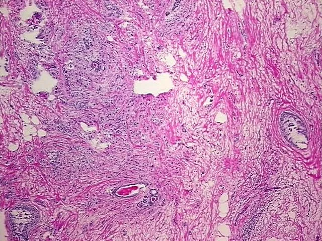 Frozen Tissue Blocks, Breast - image 1