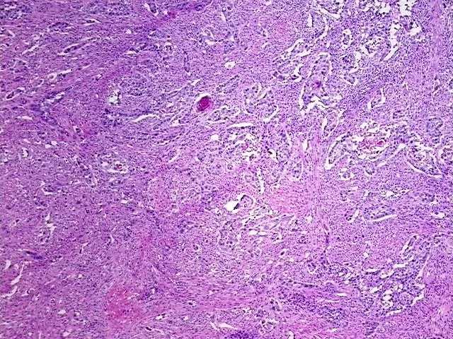 Frozen Tissue Blocks, Gallbladder - image 1