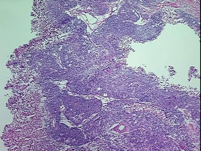 Frozen Tissue Blocks, Ovary - image 1