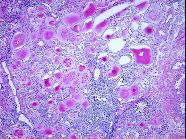Frozen Tissue Blocks, Thyroid gland - image 1