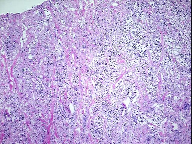 Frozen Tissue Blocks, Metastasis, unknown source - image 1