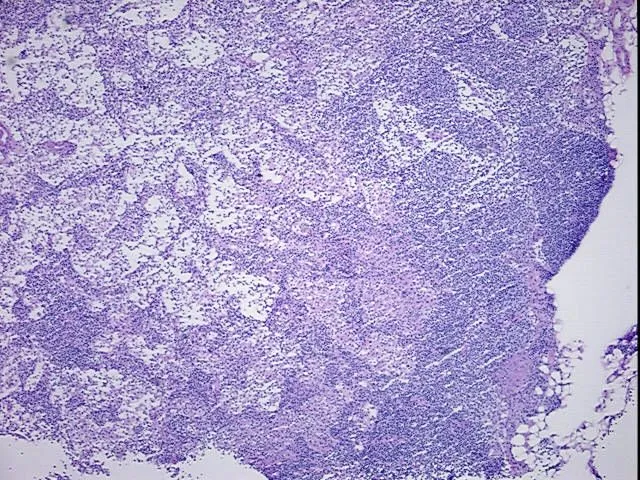 Frozen Tissue Blocks, Lymph node - image 1