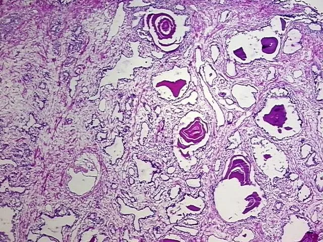 Frozen Tissue Blocks, Prostate - image 1