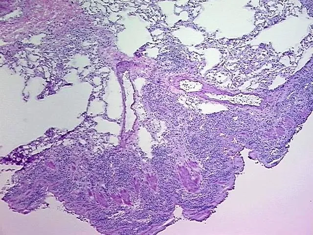 Frozen Tissue Blocks, Lymphoid tissue - image 1