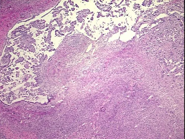 Frozen Tissue Blocks, Endometrium - image 1