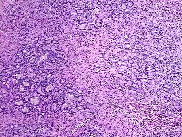Frozen Tissue Blocks, Colon - image 1