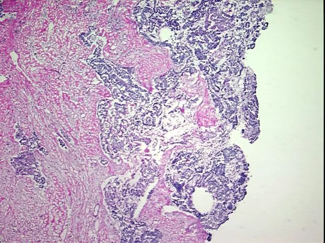 Frozen Tissue Blocks, Ovary - image 1