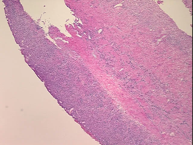 Frozen Tissue Sections, Endometriotic tissue - image 1