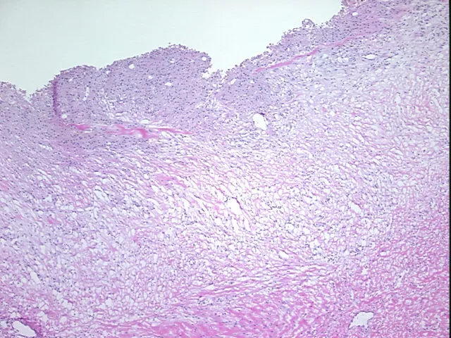 Frozen Tissue Sections, Endometriotic tissue - image 1