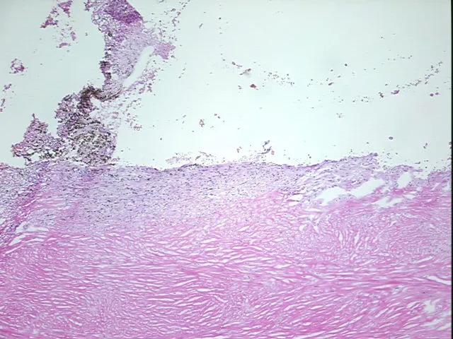 Frozen Tissue Sections, Endometriotic tissue - image 1