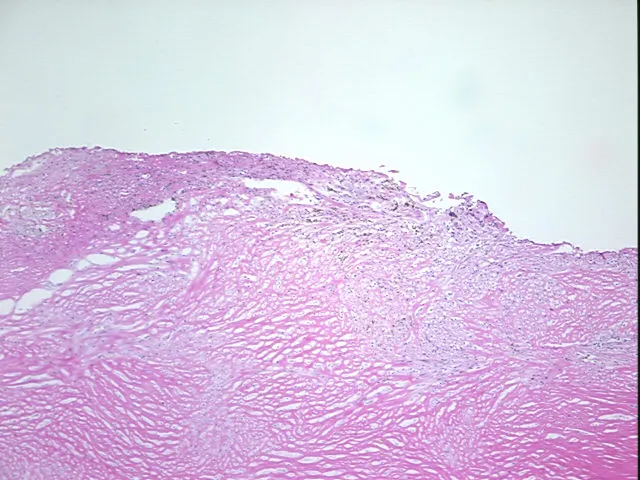 Frozen Tissue Sections, Endometriotic tissue - image 1