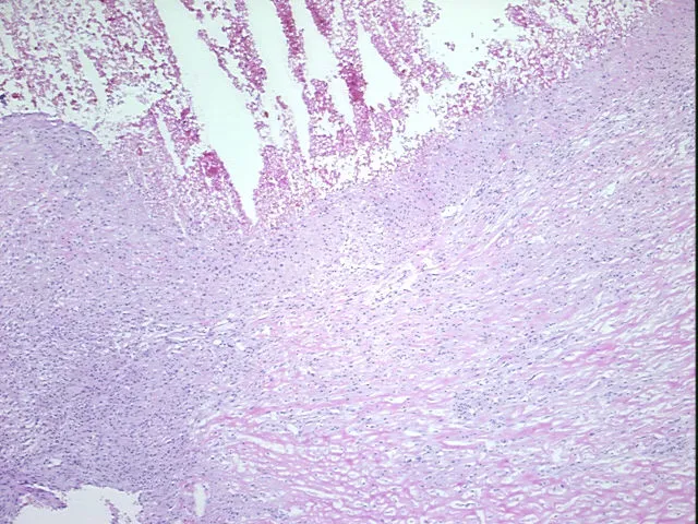 Frozen Tissue Sections, Endometriotic tissue - image 1