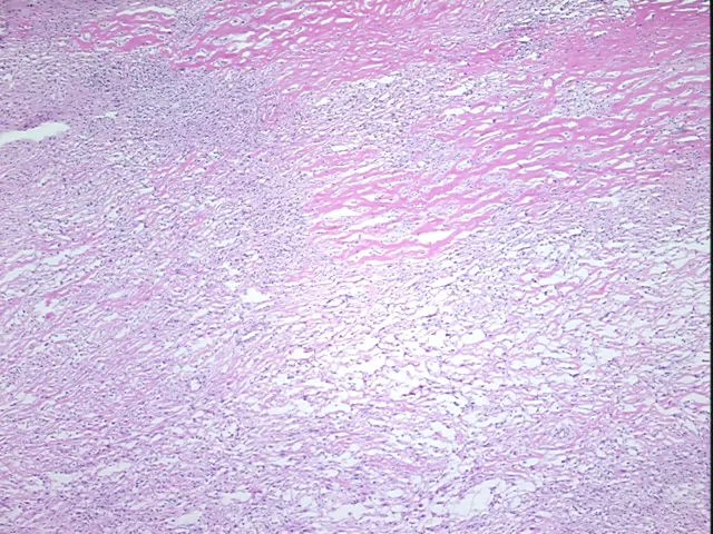 Frozen Tissue Sections, Endometriotic tissue - image 1