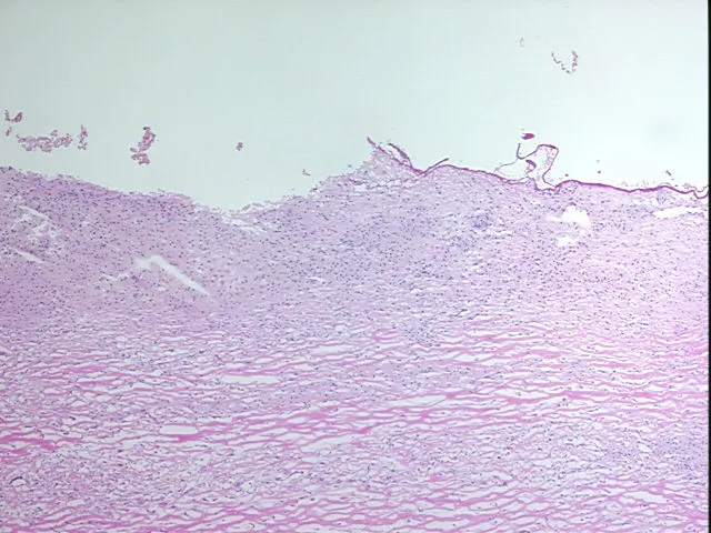 Frozen Tissue Sections, Endometriotic tissue - image 1
