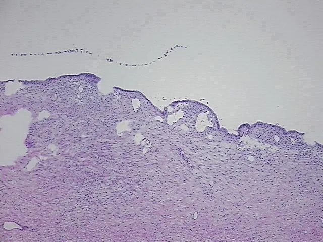 Frozen Tissue Sections, Endometriotic tissue - image 1