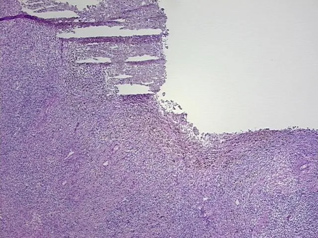 Frozen Tissue Sections, Endometriotic tissue - image 1