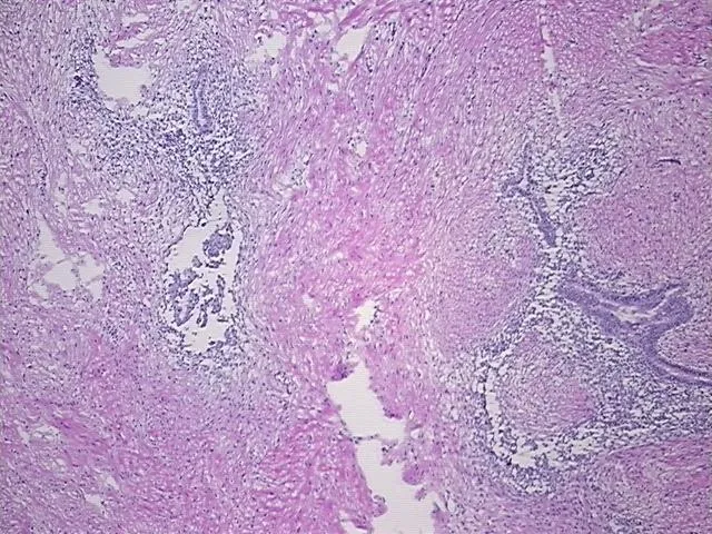 Frozen Tissue Sections, Endometriotic tissue - image 1