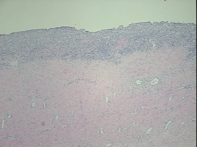 Tissue FFPE Sections, Endometriotic tissue - image 1